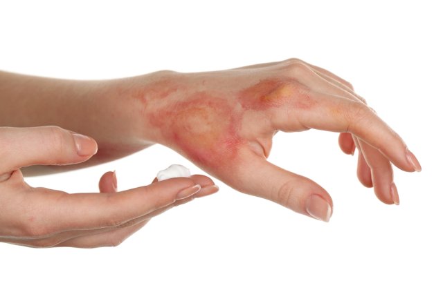 Calmează arsurile de piele: 3 metode de a trata arsurile &icirc;n condiții casnice