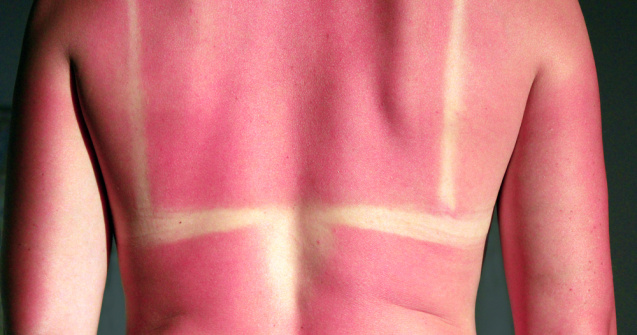  Top  Calmează arsurile solare cu ingrediente naturale