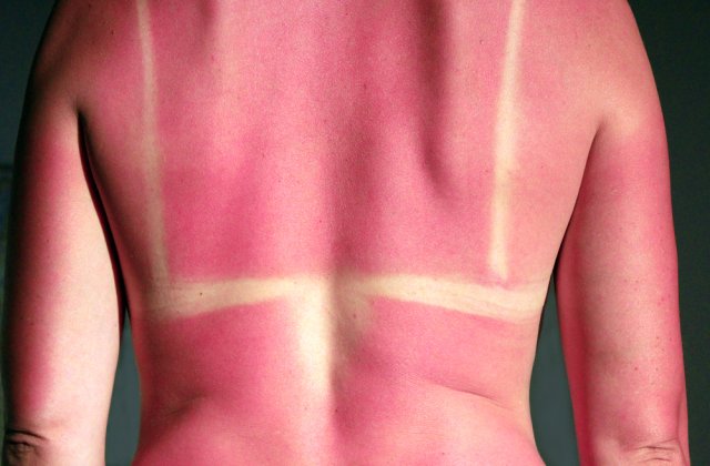 Calmează arsurile solare cu ingrediente naturale! Remedii simple pentru pielea ta