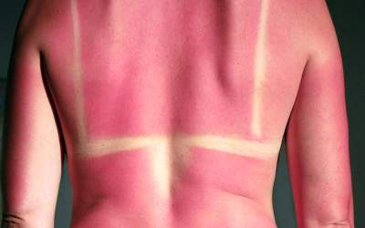 Calmează arsurile solare cu...