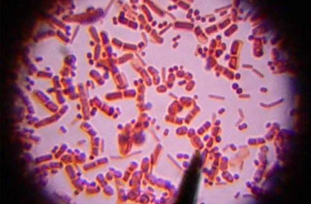 O bacterie carnivora aproape a ucis un om