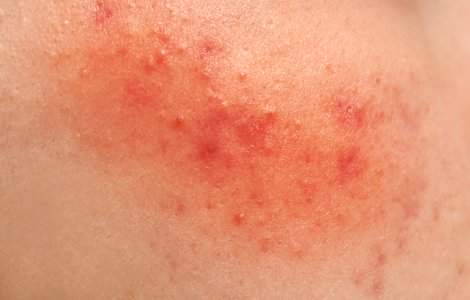  Top  Piele fină și catifelată! Cum să tratezi iritaţiile după epilat sau ras