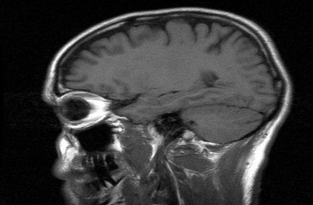 Pierderile de memorie asociate varstei a treia ar putea fi reversibile