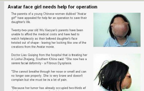 A devenit personaj Avatar din cauza unei tumori