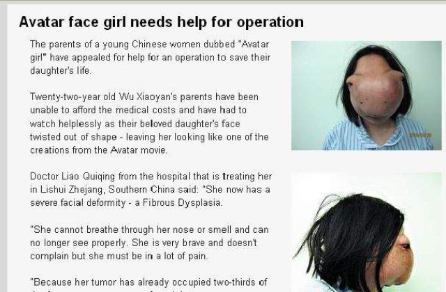 A devenit personaj Avatar din cauza unei tumori