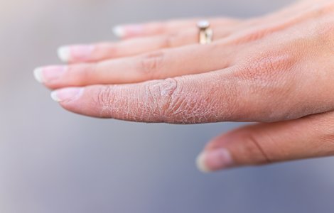  Top  6 moduri de a vă salva mâinile uscate în condiții casnice