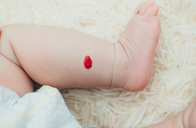 Ce semnifică punctele roșii de pe corp și ce ar trebui să faci pentru a le preveni apariția