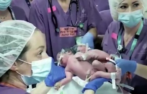 Operația de separare a două fetițe gemene siameze a fost realizată cu succes în Israel