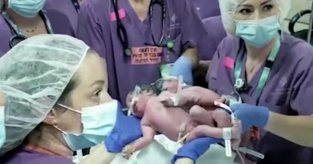 Două surori siameze au fost separate printr-o operație realizată în Israel