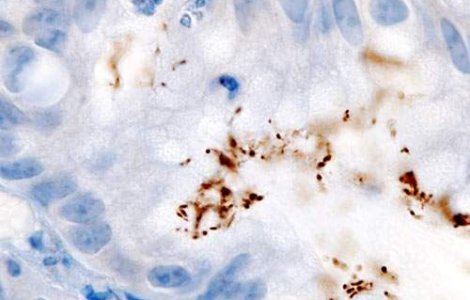 Ulcerul "modern" e mai smecher!