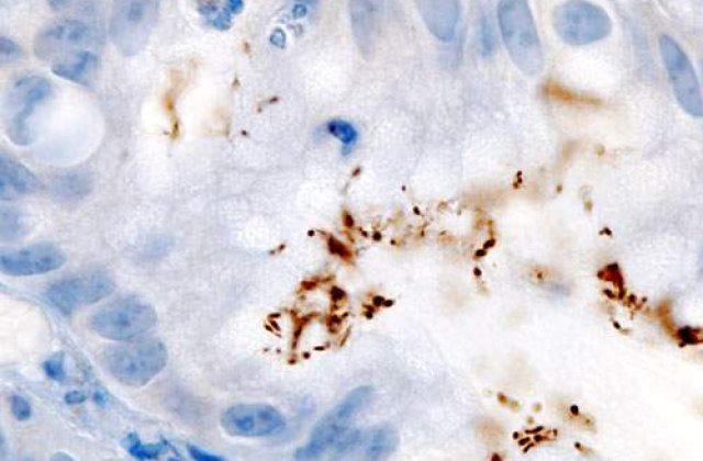 Ulcerul "modern" e mai smecher!