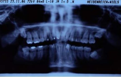 Radiografiile dentare cresc riscul de cancer