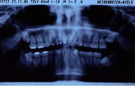 Radiografiile dentare cresc riscul de cancer