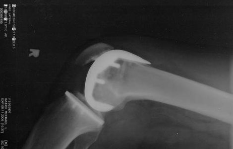 Terapie inovatoare contra artrozei in Capitala