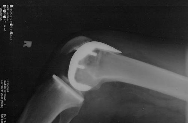 Terapie inovatoare contra artrozei in Capitala