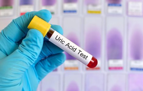 Hiperuricemia - cum gestionezi excesul de acid uric din sânge