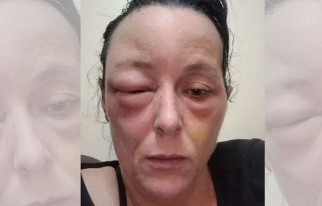 O mamă a ajuns de nerecunoscut după ce a făcut o reacție alergică la vopseaua de păr Schwarzkopf. Răspunsul companiei