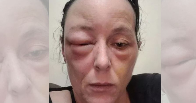 O mamă a ajuns de nerecunoscut după ce a făcut o reacție alergică la vopseaua de păr Schwarzkopf. Răspunsul companiei