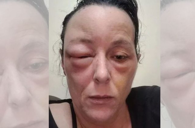O mamă a ajuns de nerecunoscut după ce a făcut o reacție alergică la vopseaua de păr Schwarzkopf. Răspunsul companiei 