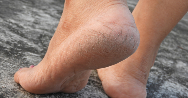  Top  Problema călcâielor crăpate. Care sunt cauzele apariției și cum le poți trata