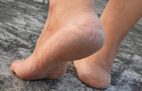  Top  Problema călcâielor crăpate. Care sunt cauzele apariției și cum le poți trata