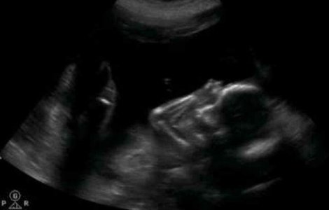 Caz incredibil in medicina: Fat de 44 de ani, gasit in corpul unei batrane