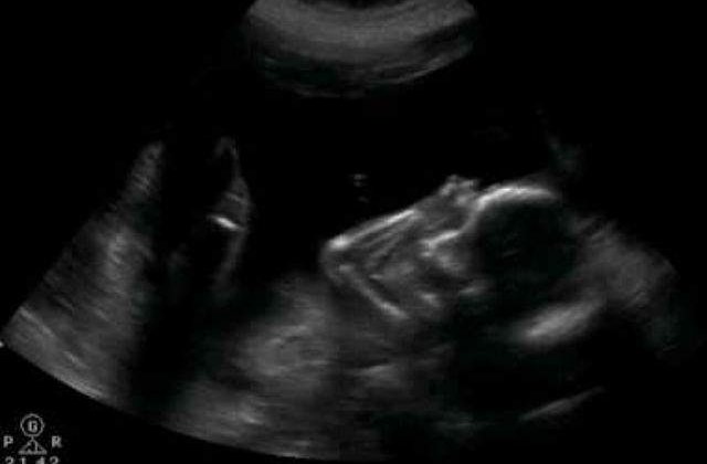 Caz incredibil in medicina: Fat de 44 de ani, gasit in corpul unei batrane