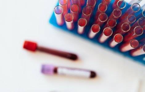 STUDIU: Cercetătorii spanioli au descoperit o posibilă metodă terapeutică de frânare a îngroșării arterelor