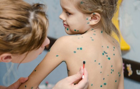 Explozie de cazuri de varicelă la Spitalul „Victor Babeş” din Timişoara