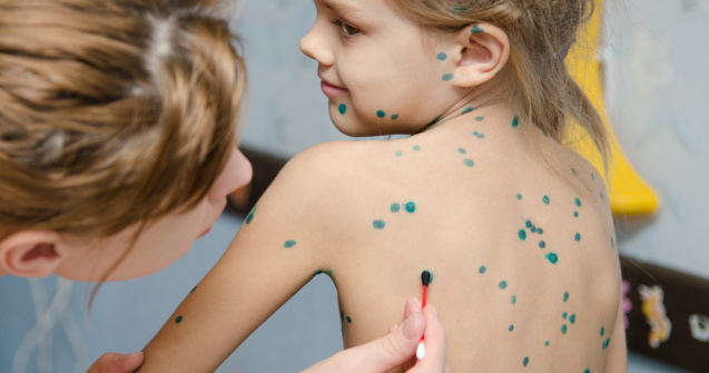 Explozie de cazuri de varicelă la Spitalul „Victor Babeş” din Timişoara