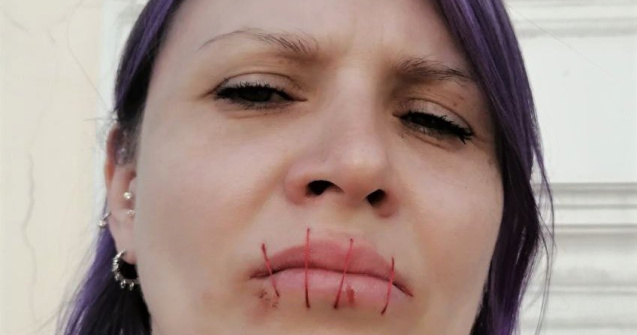 Și-a cusut gura în semn de protest față de războiul din Ucraina