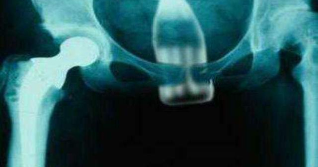  Top  Cele mai ciudate obiecte gasite in corpul uman