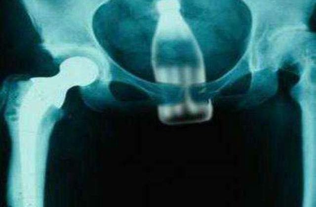 Cele mai ciudate obiecte gasite in corpul uman