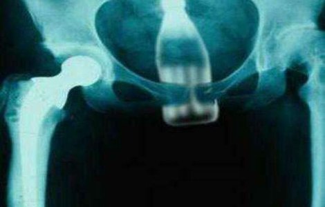  Top  Cele mai ciudate obiecte gasite in corpul uman