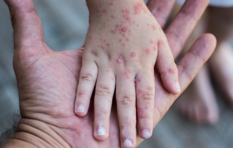 Cazuri de variola maimuței au fost depistate în țări din Europa. Ce simptome are boala