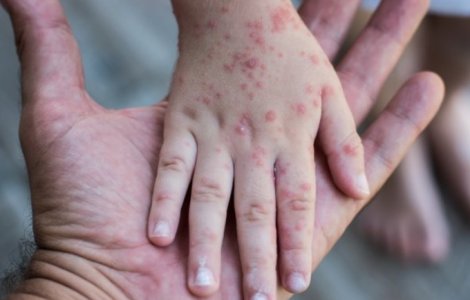 Ministerul Sănătății: Niciun caz de variola maimuței în România. Cât de periculoasă este boala și la ce simptome se recomandă vizita la medic