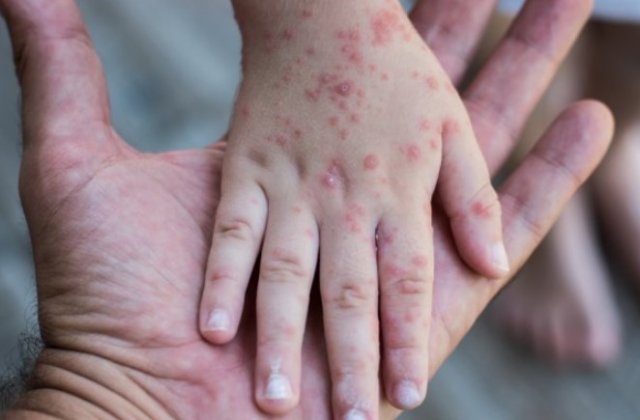 Ministerul Sănătății: Niciun caz de variola maimuței &icirc;n Rom&acirc;nia. C&acirc;t de periculoasă este boala și la ce simptome se recomandă vizita la medic