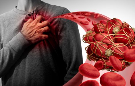 Simptome că un cheag blochează circulația sângelui în diverse părți ale corpului