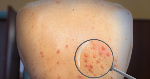 Variola maimuţei, la un pas de România. Ungaria a înregistrat primul caz