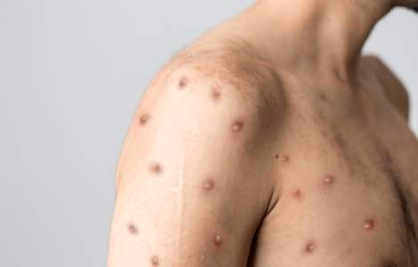 Primul caz de variola maimuței în România. Ce spune Ministerul Sănătății despre starea pacientului