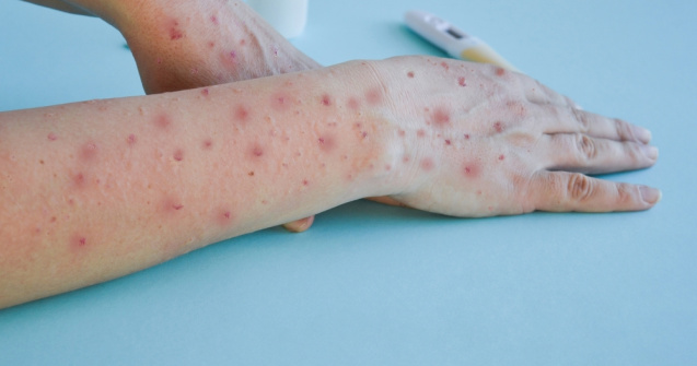 Un al cincilea caz de infectare cu variola maimuței depistat în România