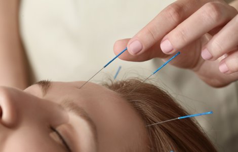 Acupunctura este un remediu benefic pentru diminuarea durerilor de cap