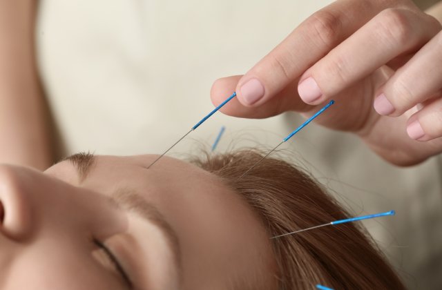 Acupunctura este un remediu benefic pentru diminuarea durerilor de cap