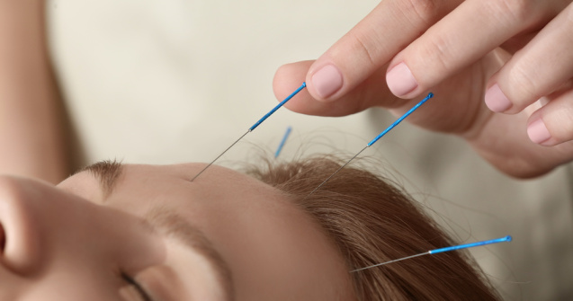 Acupunctura este un remediu benefic pentru diminuarea durerilor de cap