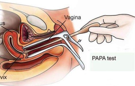 Programul pentru depistarea cancerului de col va rula si in 2014