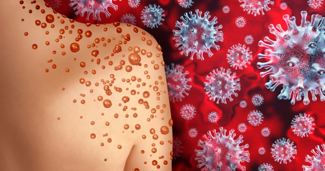 România înregistrează încă un caz de variola maimuței. Bilanțul total