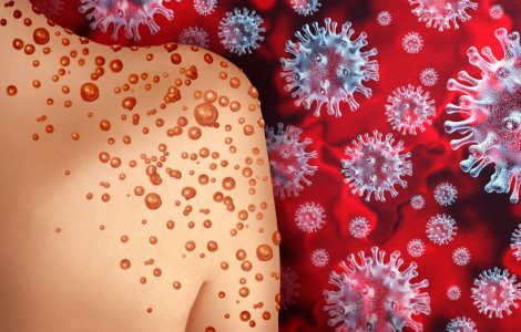 România înregistrează încă un caz de variola maimuței. Bilanțul total al infectărilor