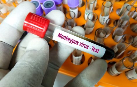 Țara în care variola maimuței a fost declarată urgență medicală