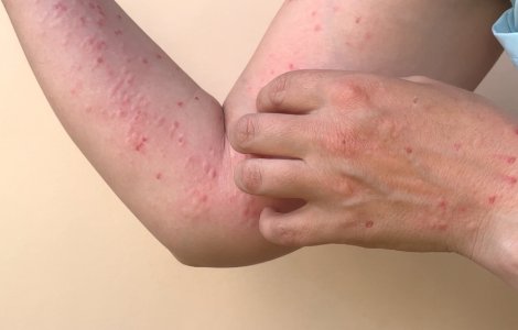 Alte două cazuri de infectare cu variola maimuței confirmate în România. Bilanțul total al cazurilor raportate