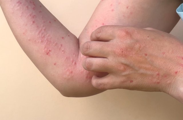 Alte două cazuri de infectare cu variola maimuței confirmate &icirc;n Rom&acirc;nia. Bilanțul total al cazurilor raportate